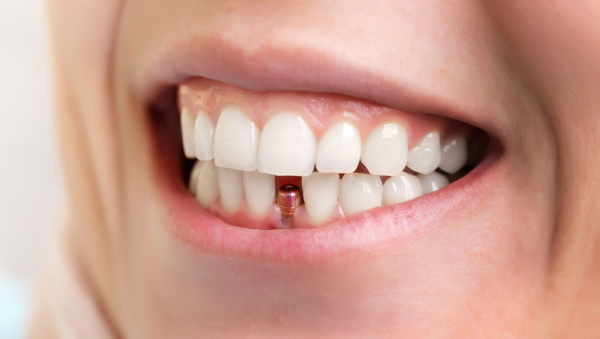 Beneficios de los implantes dentales en Campello