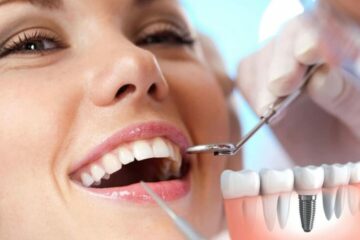 Implantes dentales en Campello